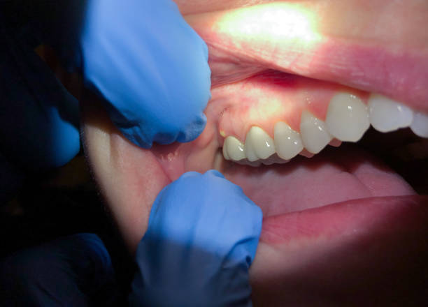 Best Urgent Tooth Repair  in Clermont, GA